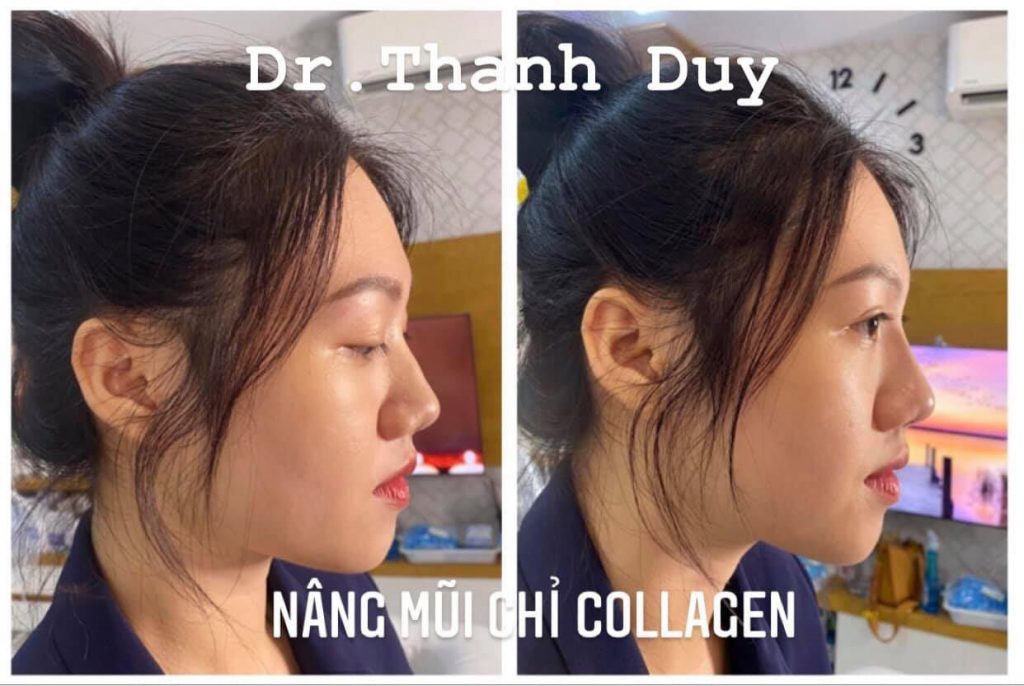 cấy chỉ collagen cấy chỉ collagen