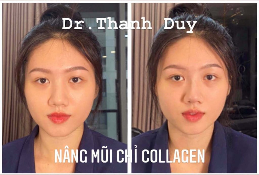 cấy chỉ nâng mũi cấy chỉ nâng mũi