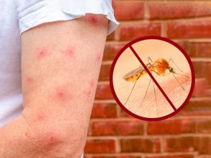 Trị vết thâm muỗi đốt lâu ngày cho bé