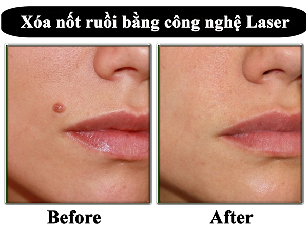 Cách tẩy nốt ruồi trong 1 ngày