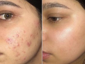 Peel vi tảo retinol có tốt không?