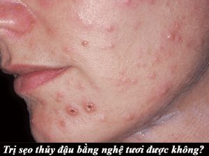 Sẹo thủy đậu