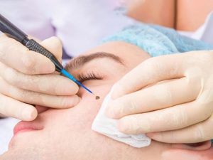 Tẩy nốt ruồi bằng đốt điện