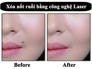 Tẩy nốt ruồi có đau không?